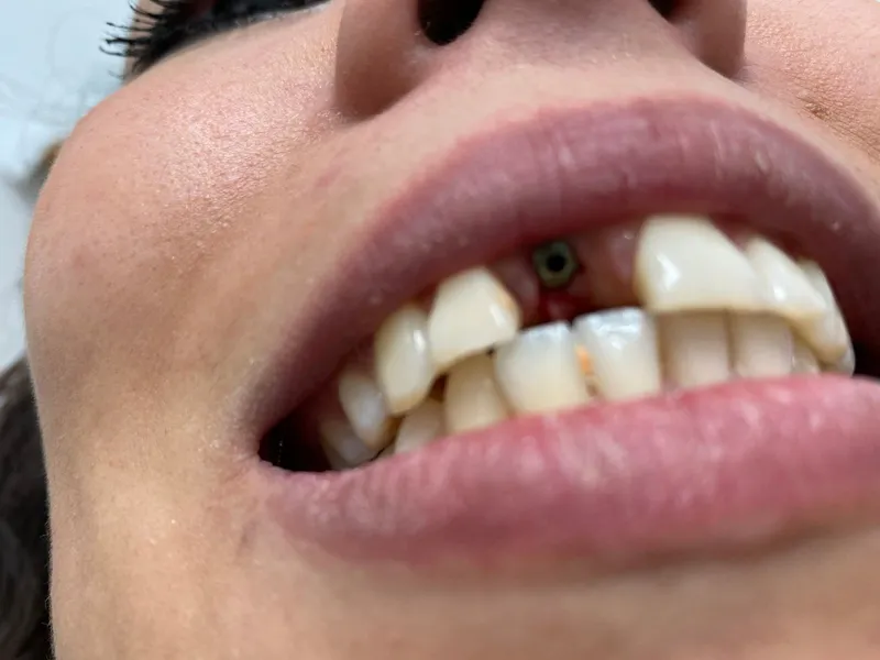 Vorher: Zahnersatz mit Implantat