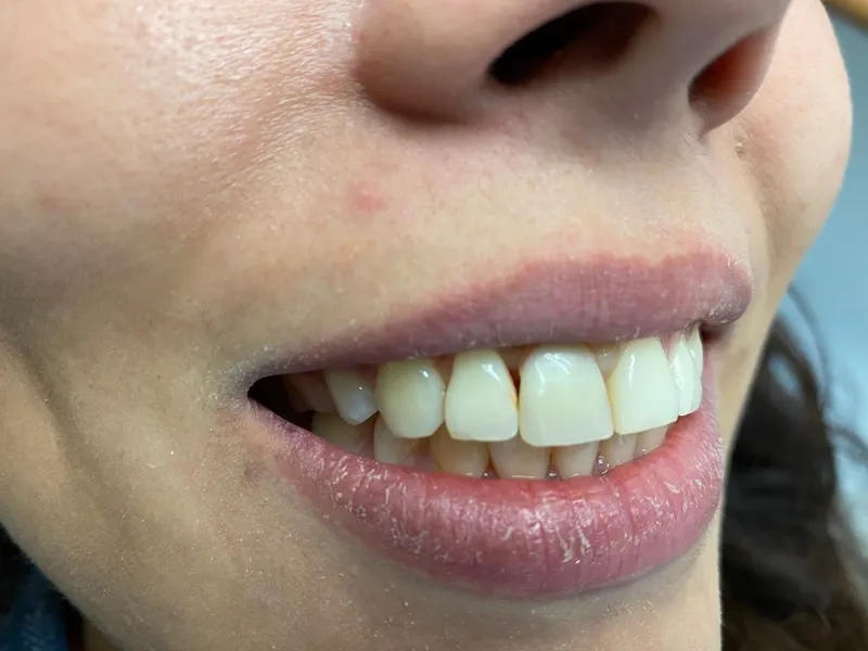 Nachher: Zahnersatz mit Implantat