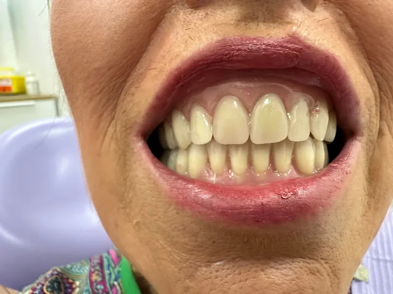 Nachher: Komplette Rehabilitation mit implantatgetragener Prothese nach massiven Parodontalschäden