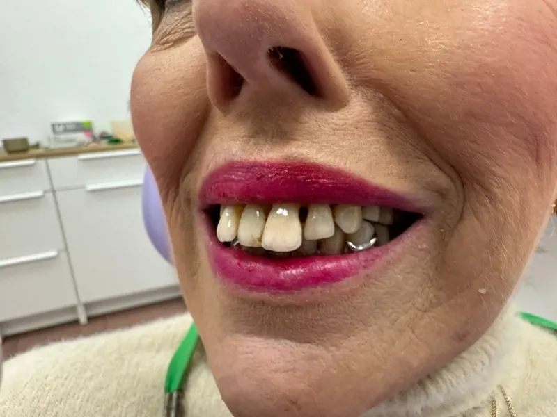 Vorher: Komplette Rehabilitation mit implantatgetragener Prothese nach massiven Parodontalschäden